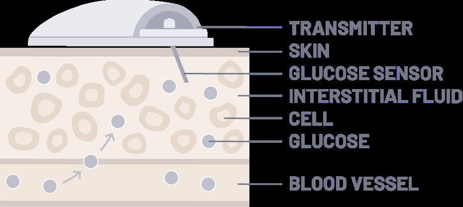 如何使用動(dòng)態(tài)血糖監(jiān)測(cè)設(shè)備(CGM)管理糖尿病 如何使用動(dòng)態(tài)血糖監(jiān)測(cè)設(shè)備(CGM)管理糖尿病