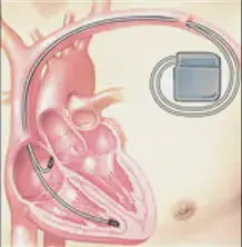 細數(shù)心臟起搏器和ICD之間的差異 細數(shù)心臟起搏器和ICD之間的差異