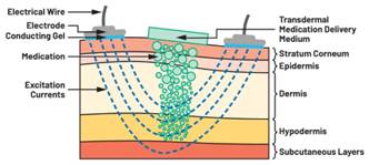 圖5.人體皮膚分層橫截面以及TMD和生物阻抗測量 考慮到生物阻抗分析的無創(chuàng)性,使用兩個金屬電極代表電氣傳感器,連接模擬前端(AFE)電路和患者皮膚。這個金屬與非金屬的接觸點是構(gòu)成整個電路的另一個關(guān)鍵部分,連接了AFE和人體電氣模型。電荷載體(電極中的電子和人體內(nèi)的離子)之間的相互作用可能對這些傳感器的性能產(chǎn)生重大影響,需要根據(jù)每種應(yīng)用進(jìn)行具體考慮。首先,金屬與離子溶液接觸的相互作用導(dǎo)致金屬表面附近溶液中離子濃度的局部變化。這種現(xiàn)象會改變電極下方區(qū)域的電荷中性,導(dǎo)致金屬周圍的電解質(zhì)電位與溶液其余部分不同,從而在金屬和電解質(zhì)主體之間產(chǎn)生一個電位差,即常說的“半電池電位”。其次,注入電流的直流分量會導(dǎo)致電極極化。 表1.各種電極類型和相應(yīng)的半電池電位 金屬及反應(yīng) 半電池電位(V) Al → Al3+ + 3e- Al → Al3+ + 3e- –1.706 –1.706 Ni → Ni2+ + 2e- Ni → Ni2+ + 2e- –0.230 -0.230 H2 → 2H+ + 2e- H2 → 2H+ + 2e- 0.000 (by definition) 0.000(根據(jù)定義) Ag + Cl- → AgCl + e- Ag + Cl- → AgCl + e- +0.223 +0.223 Ag → Ag+ + e- Ag → Ag+ + e- +0.799 +0.799 Au → Au+ + e- Au → Au+ + e- +1.680 +1.680 這是一種不良現(xiàn)象,往往導(dǎo)致電極性能下降。這些考量表明,電極也需要定義適當(dāng)?shù)碾姎饽P停▍⒁妶D6)。我們可以將干電極表示為具有三個串聯(lián)元件的電路:一個用于模擬半電池電位(EHC)的直流電源;一個用于模擬金屬和非金屬(人體)之間接觸的RC并聯(lián)電池(Rd||Cd);以及一個用于模擬電極金屬的電阻Rs。 圖5.人體皮膚分層橫截面以及TMD和生物阻抗測量 考慮到生物阻抗分析的無創(chuàng)性,使用兩個金屬電極代表電氣傳感器,連接模擬前端(AFE)電路和患者皮膚。這個金屬與非金屬的接觸點是構(gòu)成整個電路的另一個關(guān)鍵部分,連接了AFE和人體電氣模型。電荷載體(電極中的電子和人體內(nèi)的離子)之間的相互作用可能對這些傳感器的性能產(chǎn)生重大影響,需要根據(jù)每種應(yīng)用進(jìn)行具體考慮。首先,金屬與離子溶液接觸的相互作用導(dǎo)致金屬表面附近溶液中離子濃度的局部變化。這種現(xiàn)象會改變電極下方區(qū)域的電荷中性,導(dǎo)致金屬周圍的電解質(zhì)電位與溶液其余部分不同,從而在金屬和電解質(zhì)主體之間產(chǎn)生一個電位差,即常說的“半電池電位”。其次,注入電流的直流分量會導(dǎo)致電極極化。 表1.各種電極類型和相應(yīng)的半電池電位 金屬及反應(yīng) 半電池電位(V) Al → Al3+ + 3e- Al → Al3+ + 3e- –1.706 –1.706 Ni → Ni2+ + 2e- Ni → Ni2+ + 2e- –0.230 -0.230 H2 → 2H+ + 2e- H2 → 2H+ + 2e- 0.000 (by definition) 0.000(根據(jù)定義) Ag + Cl- → AgCl + e- Ag + Cl- → AgCl + e- +0.223 +0.223 Ag → Ag+ + e- Ag → Ag+ + e- +0.799 +0.799 Au → Au+ + e- Au → Au+ + e- +1.680 +1.680 這是一種不良現(xiàn)象,往往導(dǎo)致電極性能下降。這些考量表明,電極也需要定義適當(dāng)?shù)碾姎饽P停▍⒁妶D6)。我們可以將干電極表示為具有三個串聯(lián)元件的電路:一個用于模擬半電池電位(EHC)的直流電源;一個用于模擬金屬和非金屬(人體)之間接觸的RC并聯(lián)電池(Rd||Cd);以及一個用于模擬電極金屬的電阻Rs。